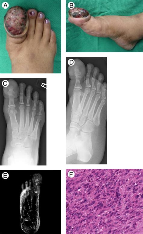 A Case Report Of Malignant Melanoma Of The Great Toe The Journal Of