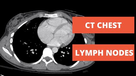 Lymph Nodes Stations Of The Chest On Ct Youtube