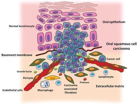 Histological And Molecular Aspects Of Oral Squamous Cell Carcinoma Review