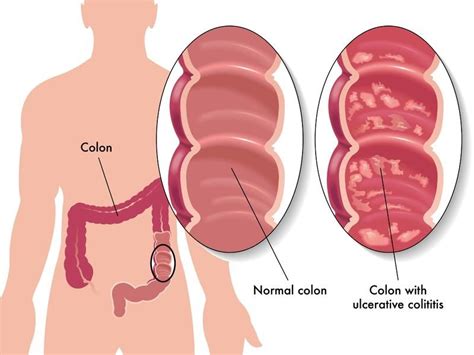 Ulcerative Colitis Causes Symptoms Diagnosis And Treatment