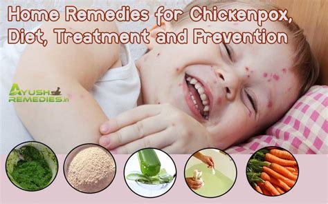 Home Remedies For Chickenpox Diet Treatment And Prevention