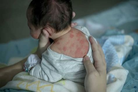 Newborn Eczema Causes Symptoms And Treatment Being The Parent