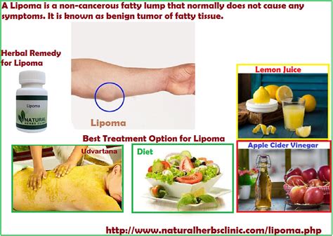 Natural Herbs Clinic Lipoma Treatment In Homeopathy Lookbook
