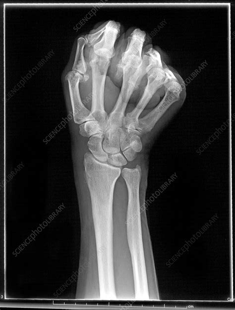 Wrist X Ray Scaphoid View Stock Image C0034813