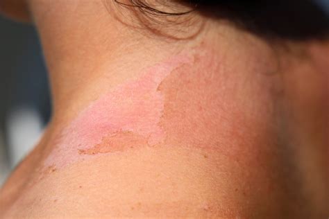 How To Get Rid Of A Sunburn Fast According To Dermatologists Allure