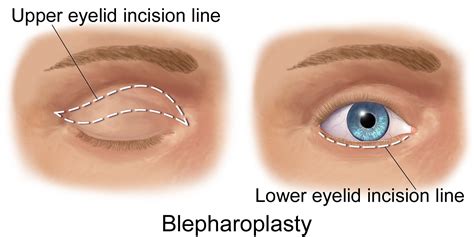 Blepharoplasty Eyelid Lift Rhinoplasty Injections Facial Implants
