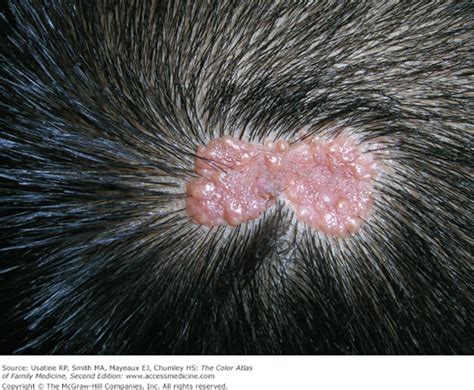 Congenital Nevus Scalp