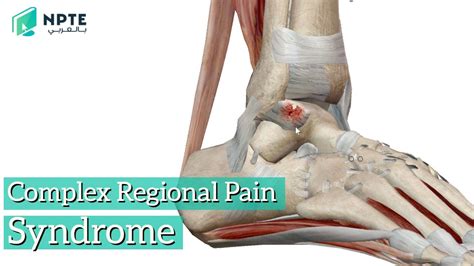 Complex Regional Pain Syndrome Crps Youtube