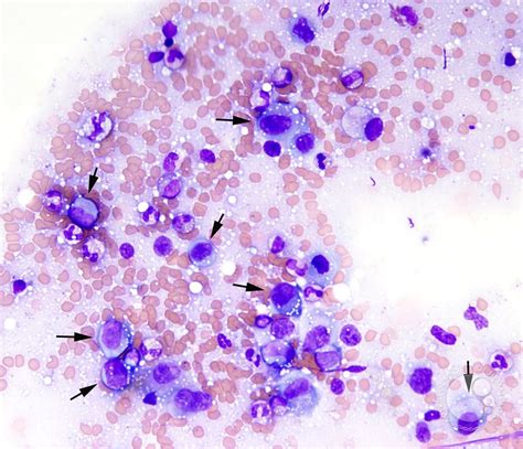 Anaplastic Large Cell Lymphoma Involving The Bone Marrow 1