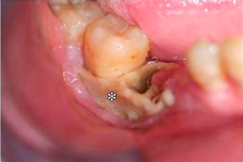 Figure 2 From Maxillary And Mandibular Osteonecrosis As A Complication