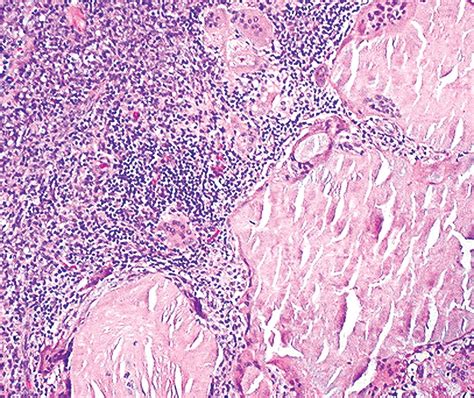 Pathology Outlines Amyloid