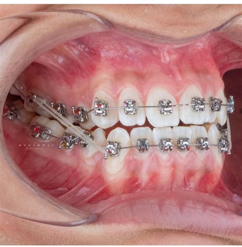 Clear Braces With Colored Rubber Bands Warehouse Of Ideas