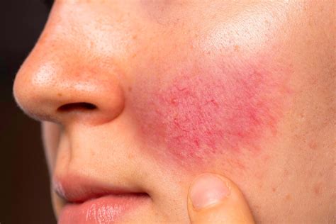 Rosacea Ursachen Symptome And Behandlung Sanubiom