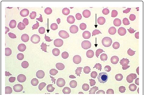 Peripheral Blood Smear Of A Patient With Microangiopathic Haemolytic