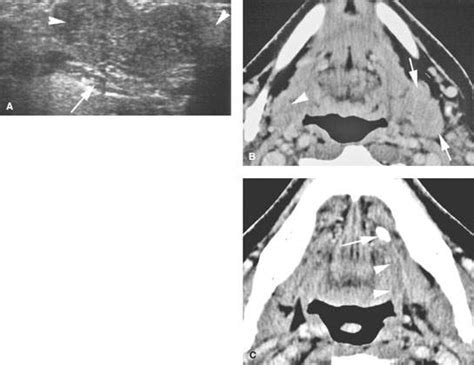 Submandibular Gland And Space Infectious And Noninfectious