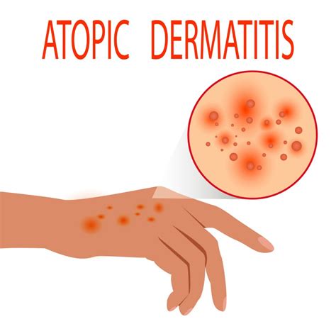 Totul Despre Dermatita Atopica Simptome Cauze Si Tratament