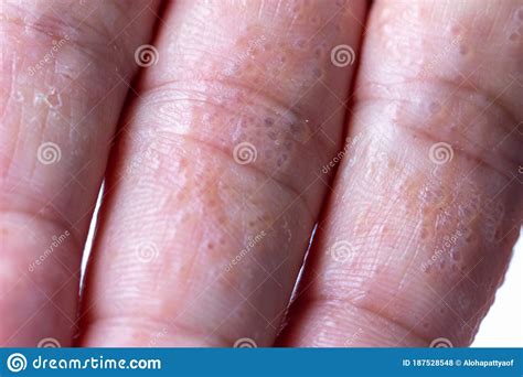 Close Up Atopic Dermatitis On Fingerad Also Known As Atopic Eczema