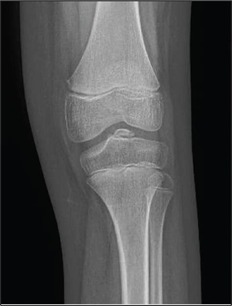 There is a fracture at the lateral tubercle of the tibial spine. Knee Injuries in the Young Athlete