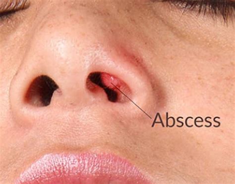 Besides, sometimes, cutting naturally curly hair too closely will result in the sharpened end of the hair piercing the skin, causing an ingrown hair. Pimple in Nose ? (How to get rid of) - (2020 - Updated)