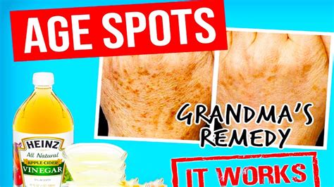 How To Remove Age Spots With Just One Ingridient Youtube