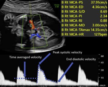 Umbilical And Middle Cerebral Artery Doppler Measurements In Fetuses