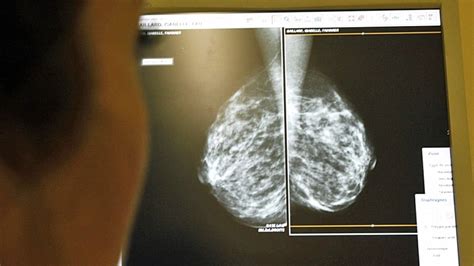 Radiotherapy After Lumpectomy Has Breast Cancer Benefits Health Cbc