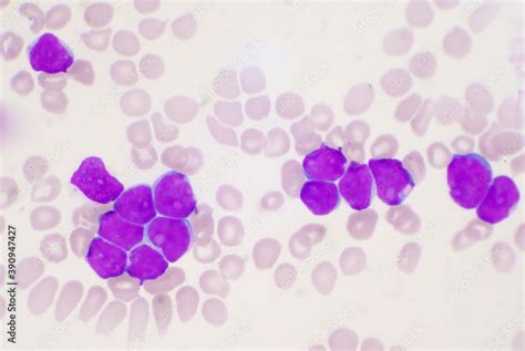 Blast Cell Of White Blood Cells In Blood Smear Stock Foto Adobe Stock