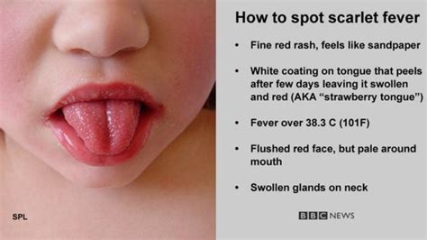 Scarlet Fever Case Numbers On The Rise In Northern Ireland Bbc News