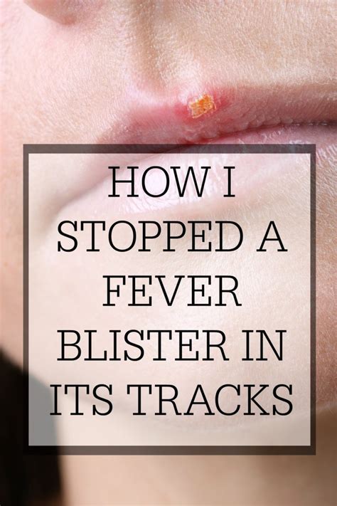 How I Stopped A Fever Blister In Its Tracks Fever Blister Fever