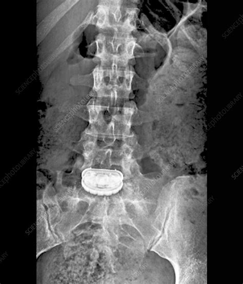 • occurs after injury • slipped or herniated disc • spinal stenosis. 'Artificial spinal disc, X-ray' - Stock Image - C002/6522 ...