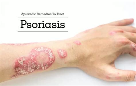 Preventing The Outburst Of Psoriasis With The Help Of Ancient Ayurveda