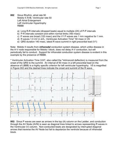 Ecg Early Precordial Rs Transition Article Blog