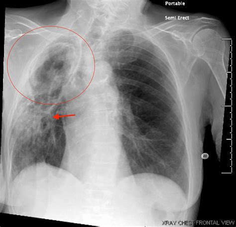 Cureus A Case Of Invasive Pulmonary Aspergillosis Vs Pulmonary