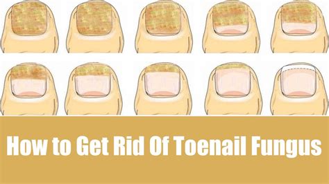 How To Naturally Get Rid Of Toenail Fungus Fast Youtube