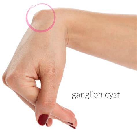 Damages Of The Ganglion Cyst In The Hand Eposts Newspaper Find And