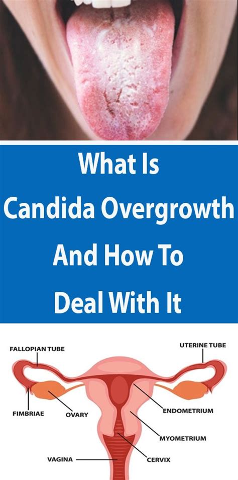 What Is Candida Overgrowth And How To Deal With It Turmeric Health