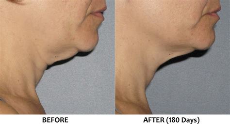 Ultherapy Sub Mental Area Loose Sagging Skin Under Chin