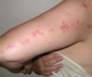 Bed Bug Bites Pictures Arm Face Legs Chest Back Babies Pest Information And Prevention