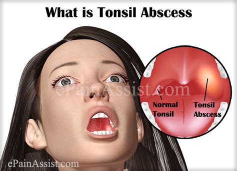 What Is Tonsil Abscess Or Throat Abscesstreatmentrecoveryprognosis