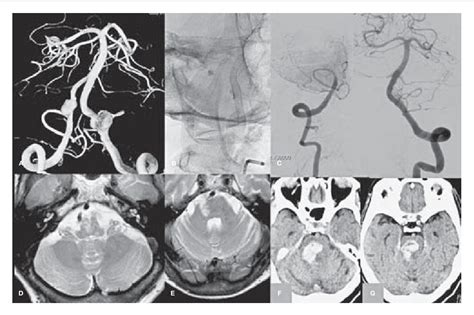 Figure 1 From Endovascular Treatment Of Intracranial Aneurysms In The