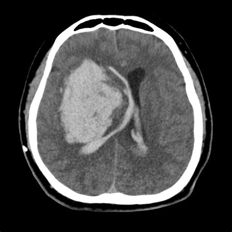 Massive Basal Ganglia Hemorrhage Bgh In Computed Tomography Ct