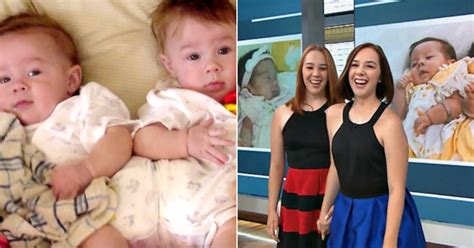 Conjoined Twins Separated Through Surgery At 7 Months Are Happy And