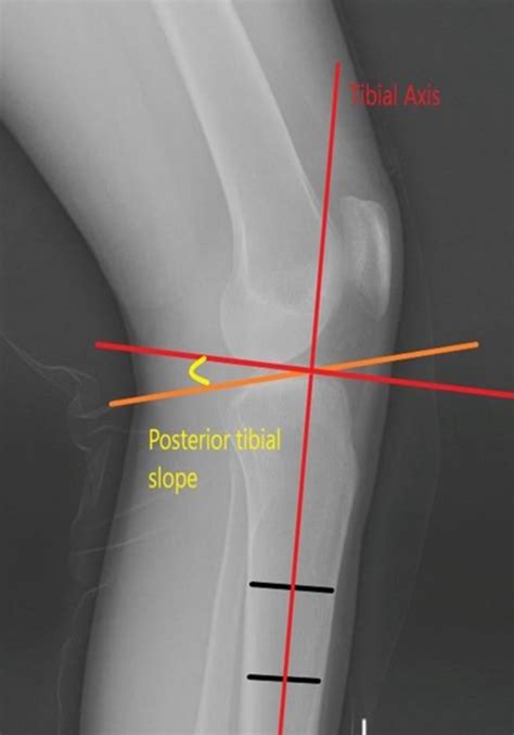 A Plain X Ray Of Lateral View Of The Right Knee Depicting The