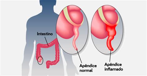 Apendicite O Que é Sintomas E Como Identificar Tua Saúde