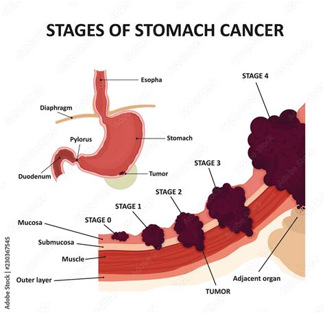 Stages Of Stomach Cancer Classification Of Malignant Tumours Stock