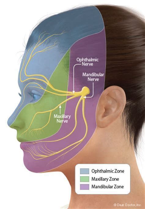 Résultat Dimages Pour What Causes Trigeminal Neuralgia Facial Nerve