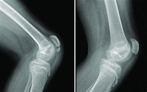 Lateral Radiographs Of The Knee Joint Showing Fragmentation Of The
