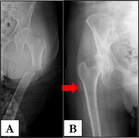 Osteoporotic Hip And Spine Fractures A Current Review Abstract
