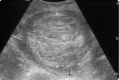Routine Use Of Abdominopelvic Ultrasonography In Severe Postpartum