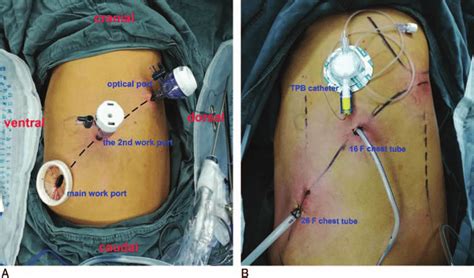 Chest Tube Types